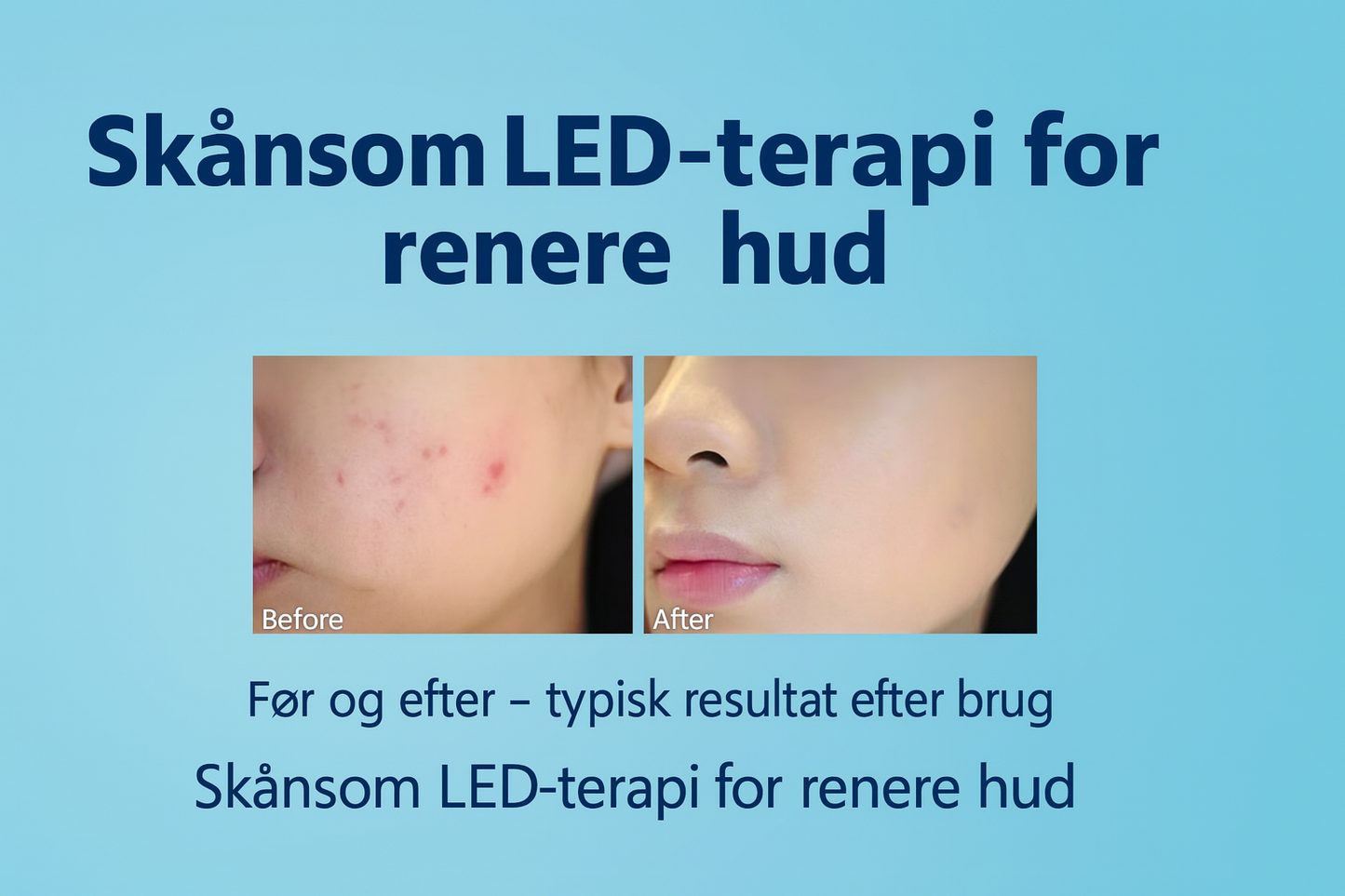 Blue Light Therapy Acne Pen – Effective against impure skin