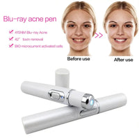 Blue Light Therapy Acne Pen – Effective against impure skin