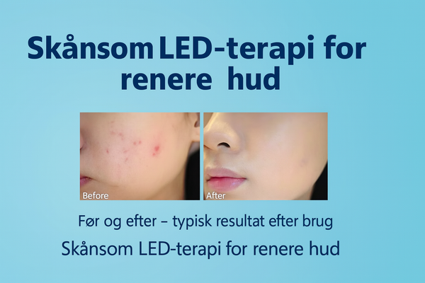Blue Light Therapy Acne Pen – Effective against impure skin